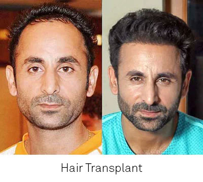 Best Hair Transplant Clinic In Bangladesh | DHI Bangladesh